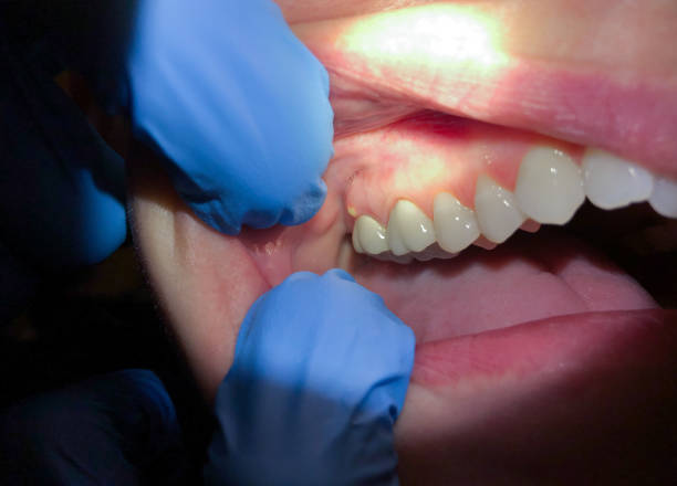 Best Emergency Denture Repair in Claremont, NC
